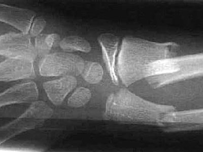 Röntgenbild einer Unterarmfraktur.