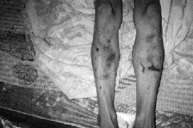 Folterspuren auf den Beinen des von Polizisten ermordeten Villistas Reyes Penagos, 17.64k